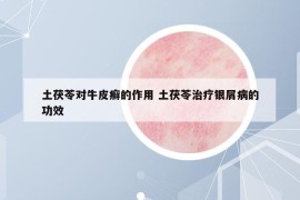 土茯苓对牛皮癣的作用 土茯苓治疗银屑病的功效