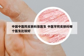 中国中医院皮肤科张医生 中医学院皮肤科哪个医生比较好