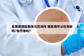 有银屑病能服海马煲汤吗 银屑病可以吃海鲜吗?有作用吗?