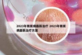 2023年银屑病最新治疗 2023年银屑病最新治疗方案