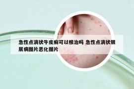 急性点滴状牛皮癣可以根治吗 急性点滴状银屑病图片恶化图片