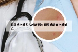 银屑病泡澡多久才能见效 银屑病患者泡澡好吗