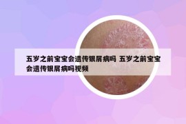 五岁之前宝宝会遗传银屑病吗 五岁之前宝宝会遗传银屑病吗视频