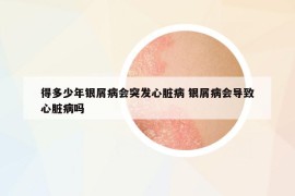 得多少年银屑病会突发心脏病 银屑病会导致心脏病吗