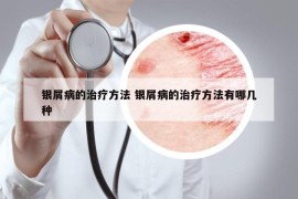 银屑病的治疗方法 银屑病的治疗方法有哪几种