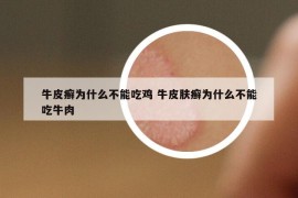 牛皮癣为什么不能吃鸡 牛皮肤癣为什么不能吃牛肉