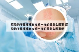 屁股沟子里瘙痒有皮癣一样的是怎么回事 屁股沟子里瘙痒有皮癣一样的是怎么回事啊