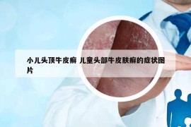 小儿头顶牛皮癣 儿童头部牛皮肤癣的症状图片