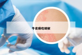 牛皮癣吃胡椒
