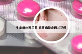 牛皮癣吃西兰花 银屑病能吃西兰花吗