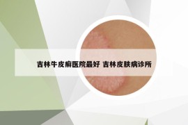 吉林牛皮癣医院最好 吉林皮肤病诊所