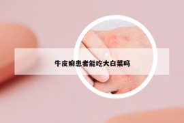 牛皮癣患者能吃大白菜吗