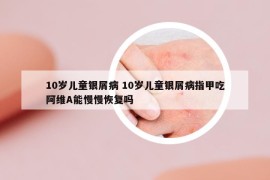 10岁儿童银屑病 10岁儿童银屑病指甲吃阿维A能慢慢恢复吗