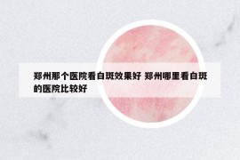 郑州那个医院看白斑效果好 郑州哪里看白斑的医院比较好