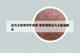 达力士软膏对牛皮癣 银屑病用达力士越涂越大