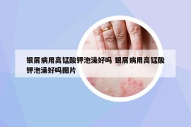 银屑病用高锰酸钾泡澡好吗 银屑病用高锰酸钾泡澡好吗图片