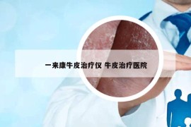 一来康牛皮治疗仪 牛皮治疗医院