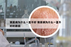 银屑病为什么一直不好 银屑病为什么一直不好的原因