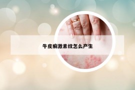 牛皮癣激素纹怎么产生