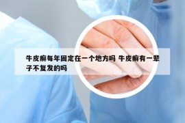 牛皮癣每年固定在一个地方吗 牛皮癣有一辈子不复发的吗