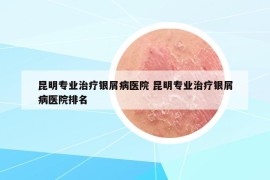 昆明专业治疗银屑病医院 昆明专业治疗银屑病医院排名