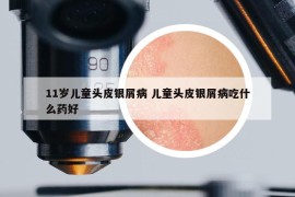 11岁儿童头皮银屑病 儿童头皮银屑病吃什么药好