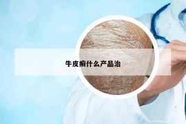 牛皮癣什么产品治