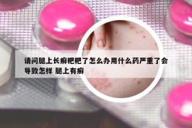 请问腿上长癣粑粑了怎么办用什么药严重了会导致怎样 腿上有癣