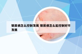 银屑病怎么控制发展 银屑病怎么能控制好不发展