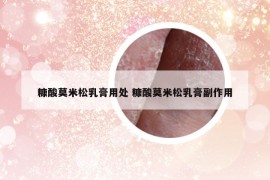 糠酸莫米松乳膏用处 糠酸莫米松乳膏副作用