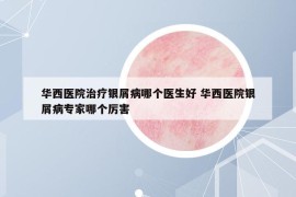 华西医院治疗银屑病哪个医生好 华西医院银屑病专家哪个厉害