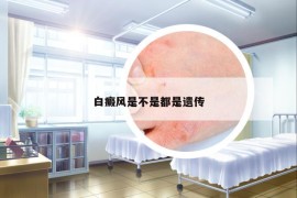 白癜风是不是都是遗传