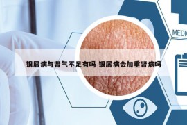 银屑病与肾气不足有吗 银屑病会加重肾病吗