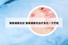 银屑病黑光仪 银屑病黑光治疗多久一个疗程