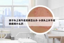 孩子头上有牛皮皮癣怎么办 小孩头上长牛皮肤癣用什么药