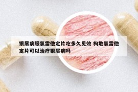 银屑病服氯雷他定片吃多久见效 枸地氯雷他定片可以治疗银屑病吗