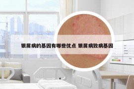 银屑病的基因有哪些优点 银屑病致病基因