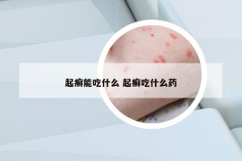 起癣能吃什么 起癣吃什么药