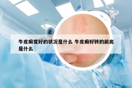 牛皮癣变好的状况是什么 牛皮癣好转的前兆是什么
