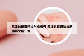 天津长征医院治牛皮癣吗 天津长征医院皮肤病哪个医生好