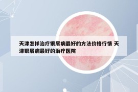 天津怎样治疗银屑病最好的方法价格行情 天津银屑病最好的治疗医院
