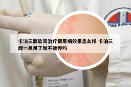 卡泊三醇软膏治疗银屑病效果怎么样 卡泊三醇一旦用了就不能停吗