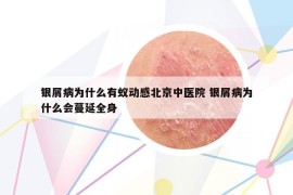 银屑病为什么有蚁动感北京中医院 银屑病为什么会蔓延全身