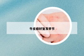 牛皮癣好复发季节