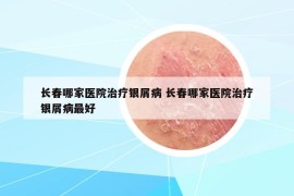 长春哪家医院治疗银屑病 长春哪家医院治疗银屑病最好