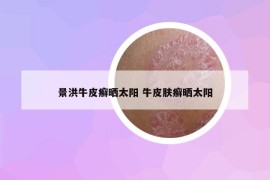 景洪牛皮癣晒太阳 牛皮肤癣晒太阳