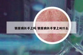 银屑病长手上吗 银屑病长手掌上叫什么