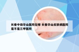 长春中级华山医院在哪 长春华山皮肤病医院是不是三甲医院