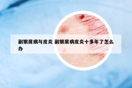副银屑病与皮炎 副银屑病皮炎十多年了怎么办