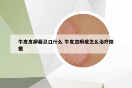 牛皮皮癣要忌口什么 牛皮血癣症怎么治疗除根